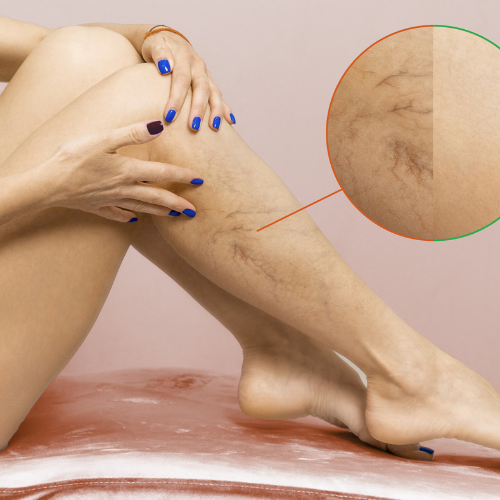 Luz intensa pulsada (IPL)